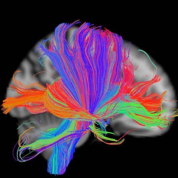 Neuroimage - Sant Pau Memory Unit - Barcelona