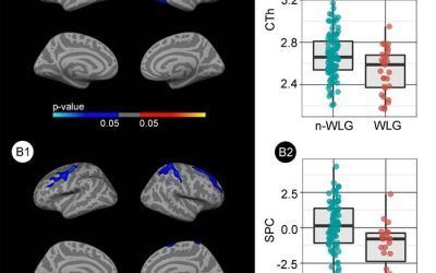 Weight loss in healthy elderly might be a sign of preclinical Alzheimer’s disease
