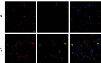 Characterization of the transcriptome of the motor cortex in amyotrophic lateral sclerosis