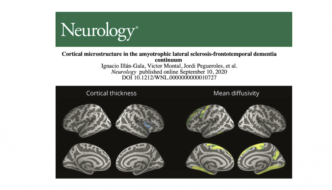 Overlapping microstructural changes in the brain of patients with ALS ...