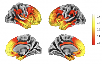 What is the value of brain atrophy in frontotemporal dementia?