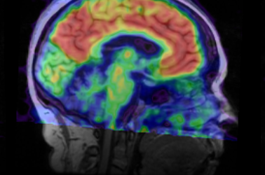 La FDA aprueba el fármaco aducanumab para la enfermedad de Alzheimer