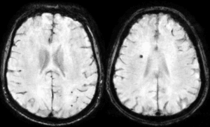 Microsangrados en adultos con Síndrome de Down: Implicaciones para el tratamiento del Alzheimer