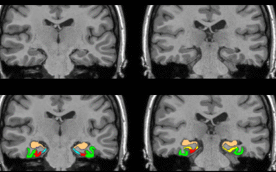 Atròfia del lòbul temporal medial en la síndrome de Down al llarg del continu de l’Alzheimer