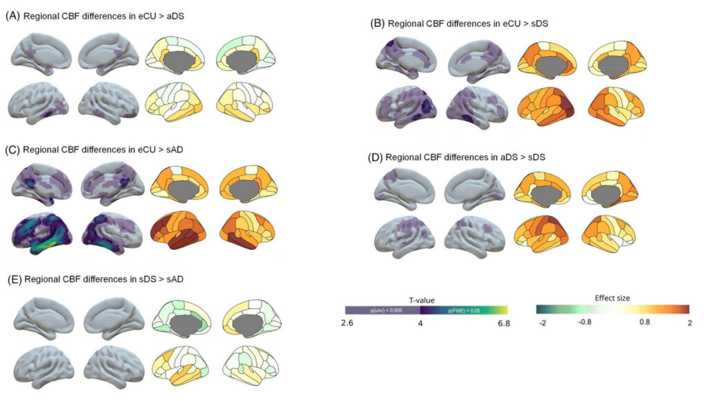 Estudio de la perfusión cerebral en adultos con síndrome de Down a lo largo del continuo de la enfermedad de Alzheimer